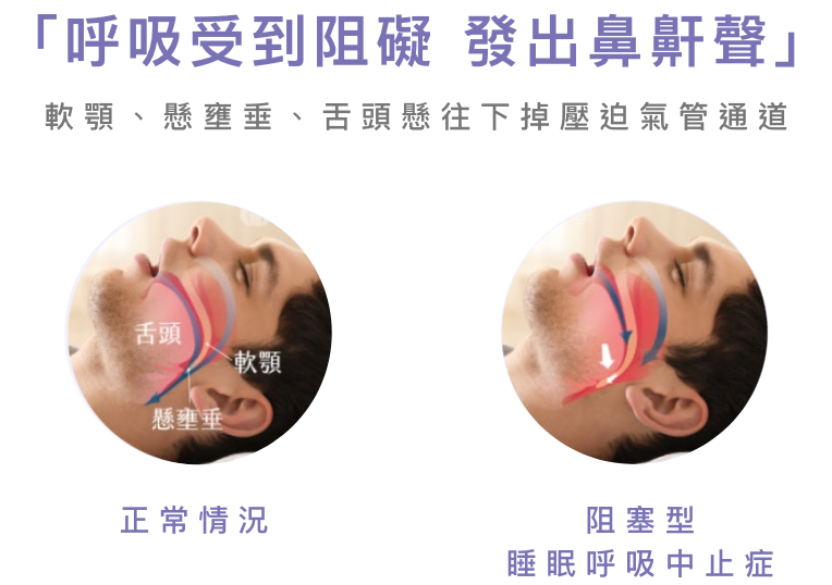 N8 去鼻鼾療程:RF射頻收緊組織 K.O.鼻鼾不復發| New Beauty