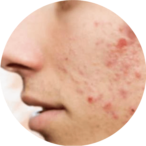 暗瘡疤痕／凹凸洞