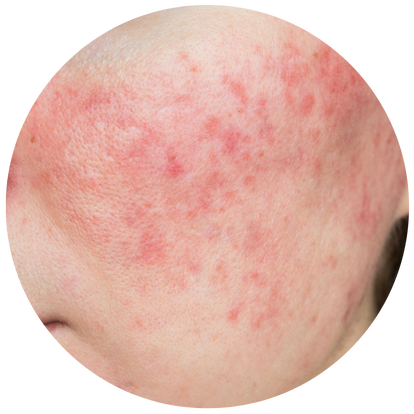 有蟹足腫體質的人士