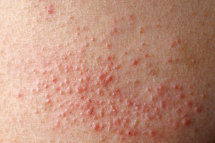 【皮膚敏感粒粒】拆解7大致敏原及止癢急救方法，敏感肌的去瘡去印療程推介