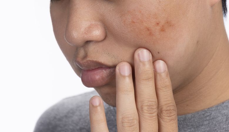 【蝴蝶斑全攻略】點止肝斑咁簡單？揭開 6 大成因與 4 種中西醫去斑法！