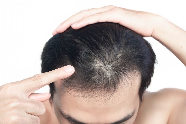 【男人禿頭原因】雄風保衛戰：5大男士脫髮原因+對症下藥的頭髮重生策略