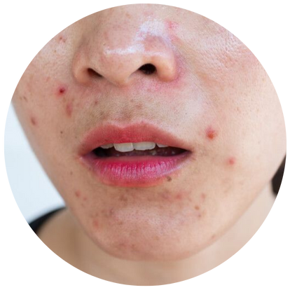 同一位置反覆生暗瘡