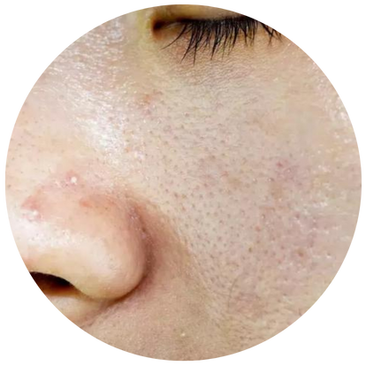 先天性油性皮膚