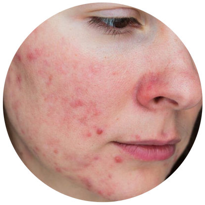 泛紅血管型玫瑰痤瘡