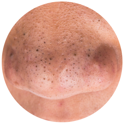 鼻頭的黑頭粉刺