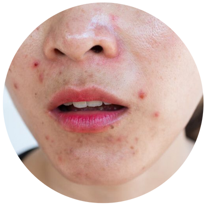 毛囊單位摘取術 (FUE)