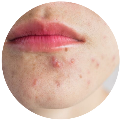 後天性油性皮膚