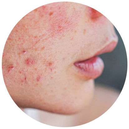 毛囊單位移植術 (FUT)