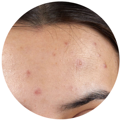 留下深色暗瘡印