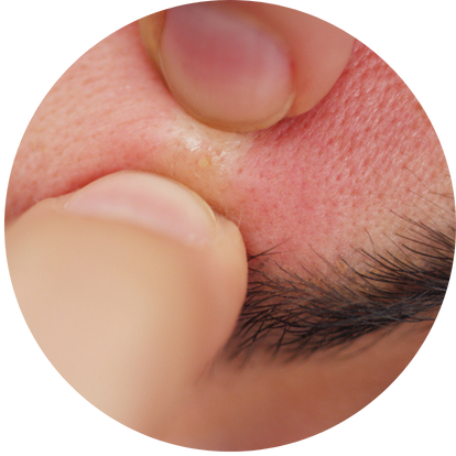 小膿頭眉心暗瘡