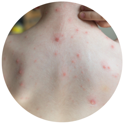 暗瘡反覆長在同一位置