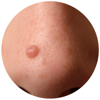 鼻頭生瘀黑色瘡