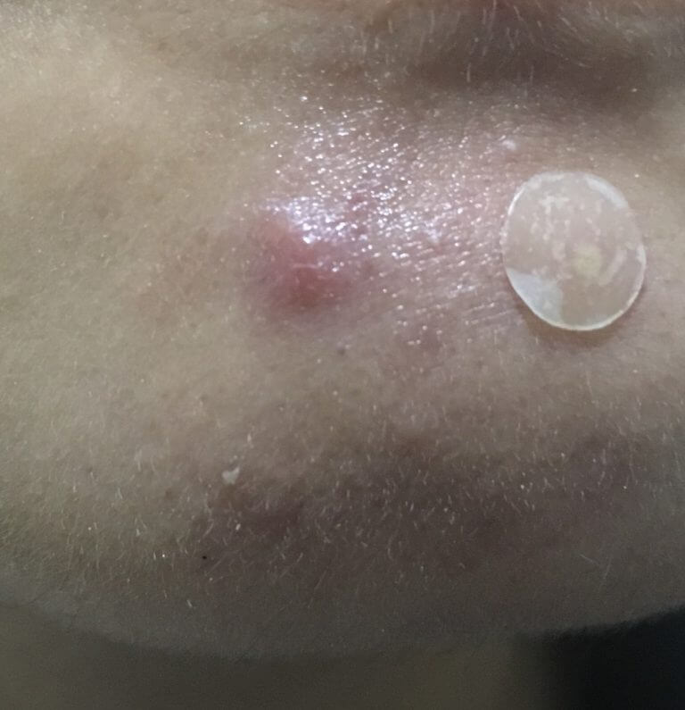 體積比一般暗瘡更大