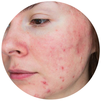 暗瘡、粉刺增多