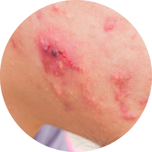 長有石頭瘡的人士