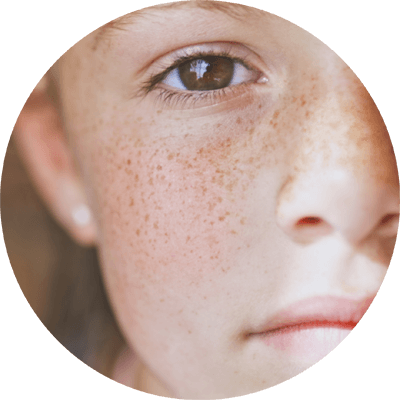 因腎陰不足而出現的色斑真皮型