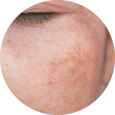 因肝鬱氣滯而出現的色斑