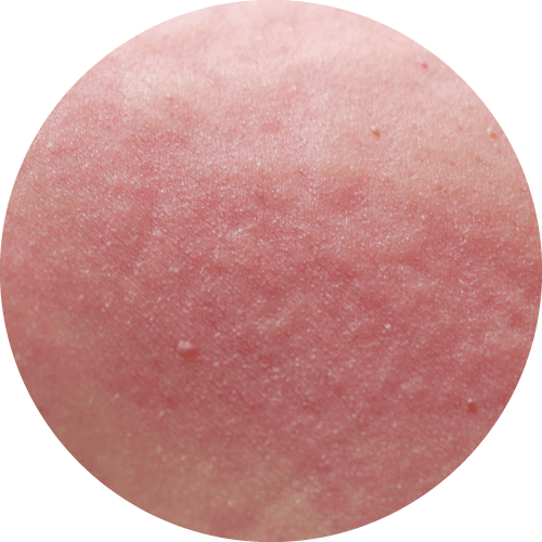 患有慢性皮膚疾病的人士