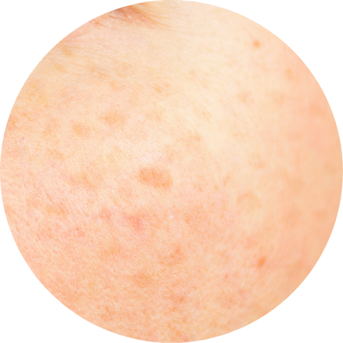 有蟹足腫體質的人士