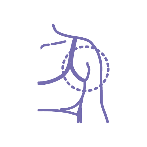 毛囊單位摘取術 (FUE)