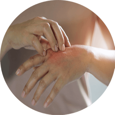 具過敏反應人士