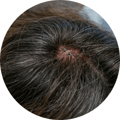 頭皮毛囊堵塞 